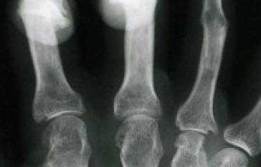 Xray of Hand